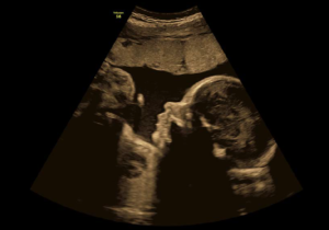 USG ginekologiczne Warszawa cena